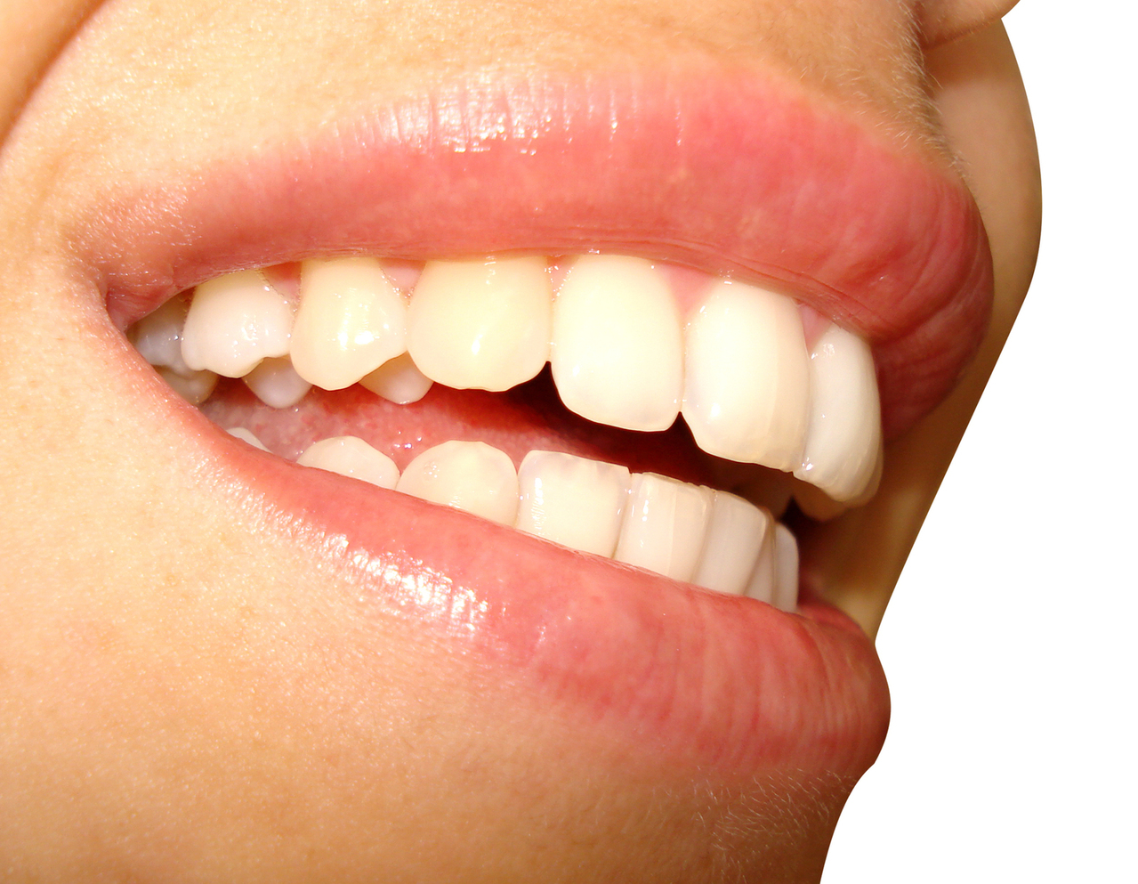 Chipped Tooth? Here Are Your Options • Southeast Dental
